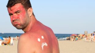 Der Sonnenbrand – Wissen, Vorbeugung und Behandlung